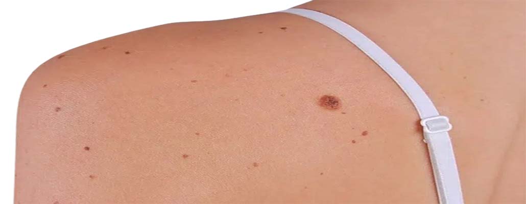 Remove skin tags