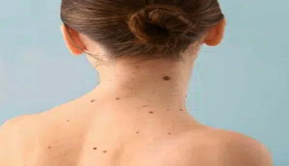 Remove skin tags